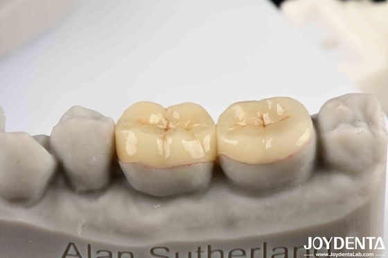 Emax Inlay ออนไล สภาพถูกต้องและ Hypoallergenic Biocompatibility ง่ายในการทําความสะอาด