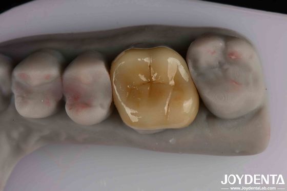 ผ่านแสงกลาง Emax Inlay Onlay ทําความสะอาดง่ายและไม่เป็นพิษ Biocompatibility ในวัสดุ