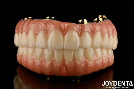 ฟันธรรมชาติและยางเขี้ยว สะพานไฮบริด Ti-Bar Zirconia ที่เข้ากันได้