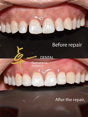 บอกทักทายกับรอยยิ้มที่บริสุทธิ์ ด้วยฟีนเนอร์ฟันตัลโครสติก ไม่มีการเปลี่ยนสี ไม่มีการเตรียม