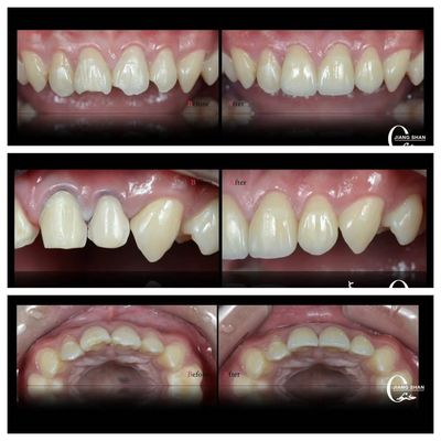 สีฟันธรรมชาติ สําหรับรอยยิ้มที่ธรรมชาติและสวยงาม