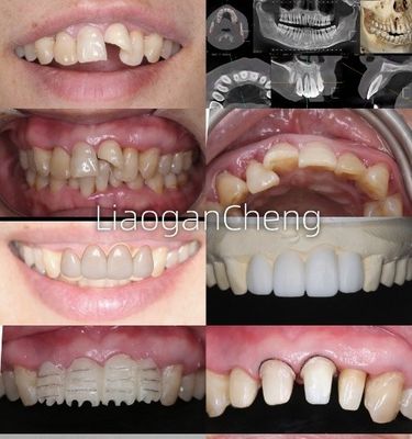 ความเหมาะสมทางชีวภาพ ราชทานฟันซิกอร์โคนียที่ปลอดภัย สําหรับการฟื้นฟูที่ใช้ในระยะยาวและพยาบาลที่สนับสนุนการปลูก
