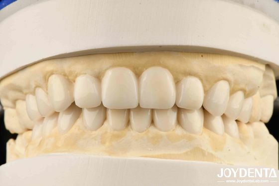 การจำลองทางชีวภาพเพื่อความสวยงามของฟัน การวินิจฉัยด้วย Wax-Up สำหรับวีเนียร์