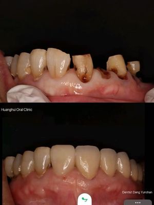 ครอบฟันพรีเมียมเซอร์โคเนียสำหรับห้องปฏิบัติการทันตกรรมทั่วโลก | JOY Dental Lab