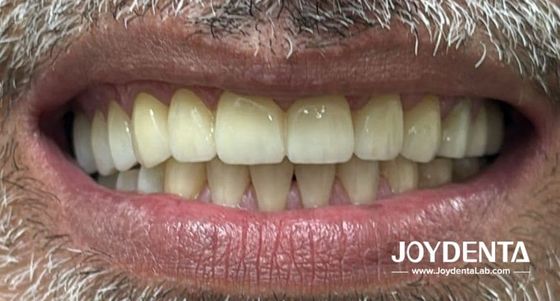 ฟันปลอมเซอร์โคเนียที่เลียนแบบฟันธรรมชาติ