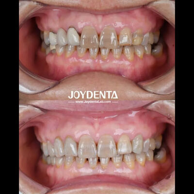 เซอร์โคเนียสำหรับทันตกรรมน้ำหนักเบาเพื่อประสบการณ์ที่ดีที่สุดของผู้ป่วย สีธรรมชาติ