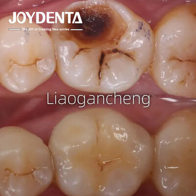 โปรเซลีนฟัน Inlay การฟื้นฟูสําหรับผู้ใหญ่และเด็ก
