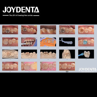 ผู้ใหญ่ เด็ก โปรเซลิน เซรามิค อินเลย์ฟัน